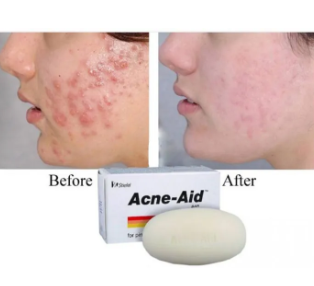 Stiefel Acne-Aid Exfoliating Body Soap Bar for Pimple-Prone/Oily Skin 100g