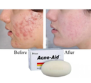 Stiefel Acne-Aid Exfoliating Body Soap Bar for Pimple-Prone/Oily Skin 100g